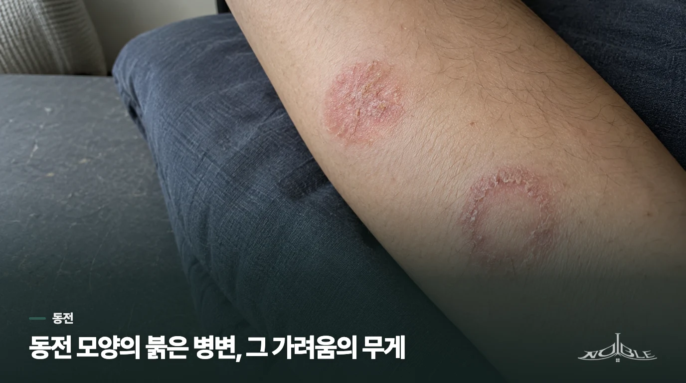 동전 모양의 붉은 병변, 그 가려움의 무게