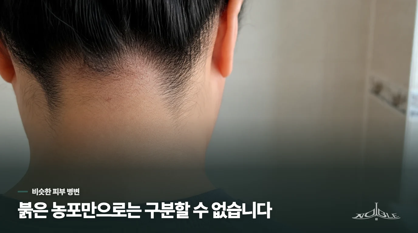 붉은 구진과 노란 농포만으로는 여드름인지 모낭염인지 가르기 어렵습니다