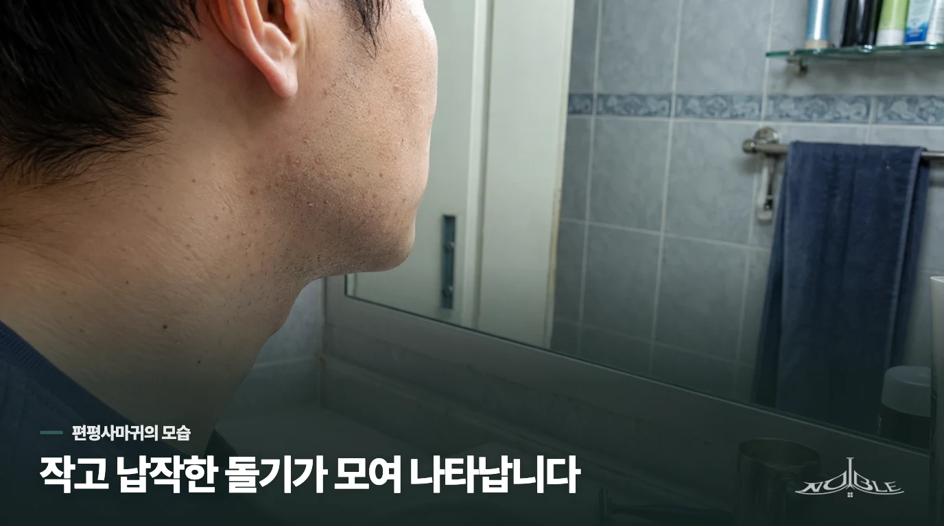 면도한 턱과 다리에 작고 납작한 돌기가 모이면 편평사마귀를 살핍니다