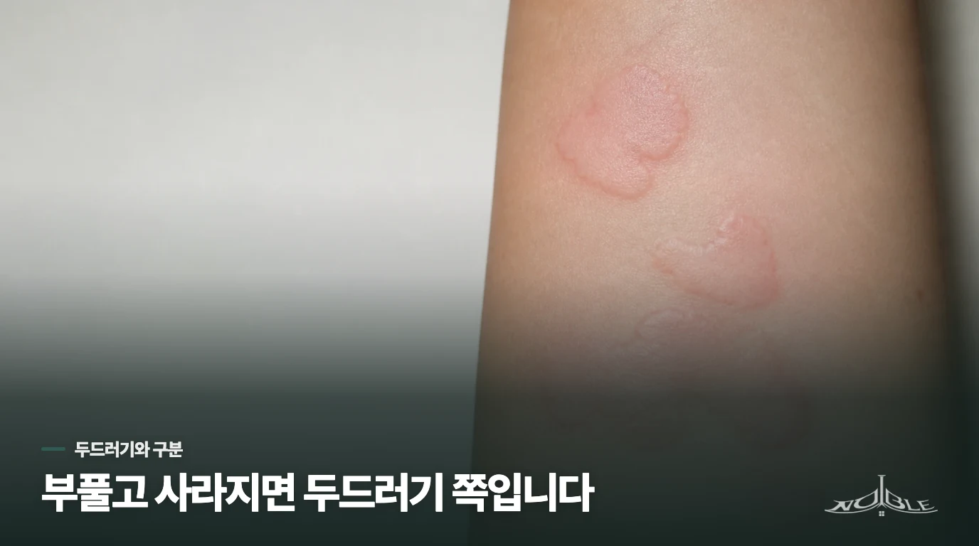 가렵고 부풀었다가 사라지면 두드러기, 납작하면 자반증 쪽입니다